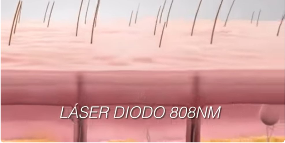 Depilación Láser soprano